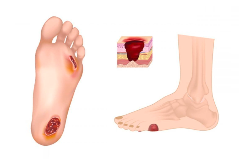 pie-diabetico-salud-humana