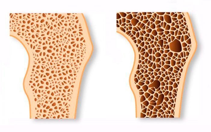 Perdida de la densidad de un hueso: a la izquierda un hueso sano y a la derecha un hueso con osteoporosis